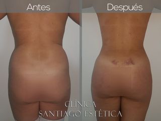 LIPOESCULTURA + LIPOTRANSFERENCIA A GLÚTEO 