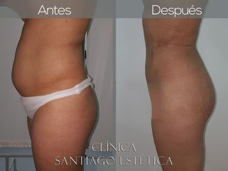 LIPOESCULTURA + LIPOTRANSFERENCIA A GLÚTEO 
