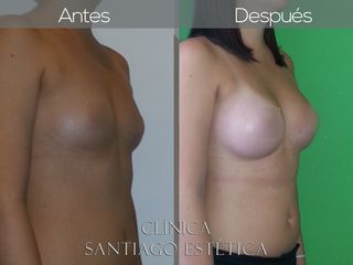 Mamoplastia de Aumento