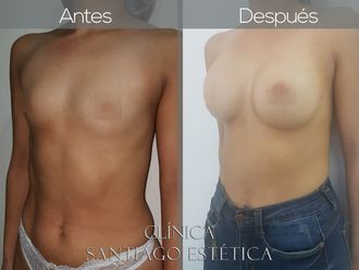 Aumento mamario - 627173