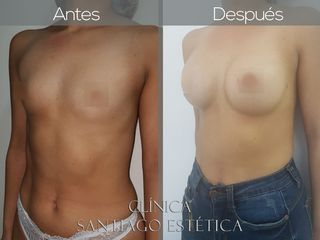 Implante Mamario