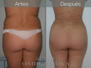 lipoescultura 