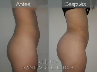 lipoescultura y lipofilling