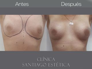 IMPLANTE MAMARIO Clínica Santiago Estética