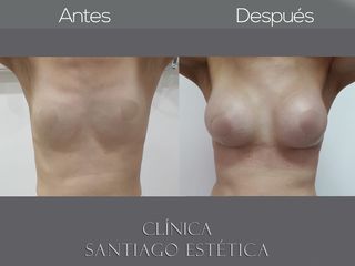 IMPLANTE MAMARIO Clínica Santiago Estética 