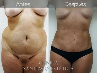 Lipoescultura