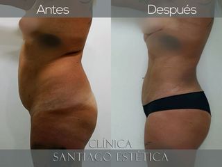 Lipoescultura