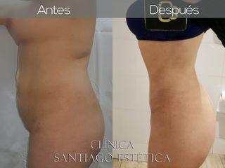 CASOS abdomino + lipo