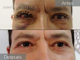 Clínica Santiago Estética - Blefaroplastia