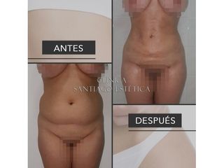 Clínica Santiago Estética - Liposucción
