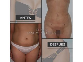 Clínica Santiago Estética - Liposucción