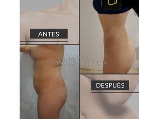 Clínica Santiago Estética - Liposucción