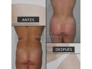 Clínica Santiago Estética - Liposucción