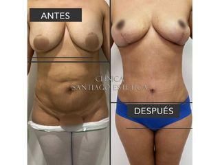 Clínica Santiago Estética - Lipoadiminoplastia + pexia