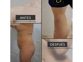Clínica Santiago Estética - Abdominoplastia