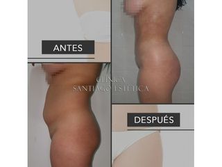 Clínica Santiago Estética - Abdominoplastia