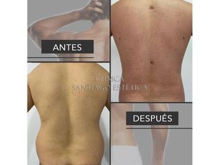 Clínica Santiago Estética - Liposucción