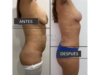 Clínica Santiago Estética - Lipoadiminoplastia + pexia