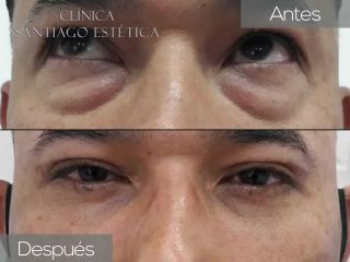 Blefaroplastia - Clínica Santiago Estética