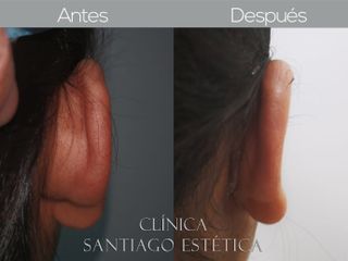 Otoplastia - Clínica Santiago Estética