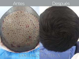 Implante Capilar - Clínica Santiago Estética