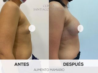 Aumento mamario - Clínica Santiago Estética