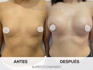 Aumento mamario - Clínica Santiago Estética