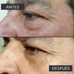 Blefaroplastia - Clínica Santiago Estética