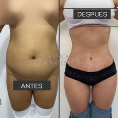 Liposucción - Clínica Santiago Estética