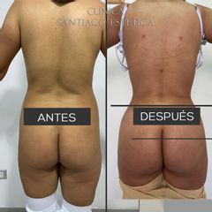 Liposucción - Clínica Santiago Estética