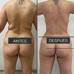 Liposucción - Clínica Santiago Estética