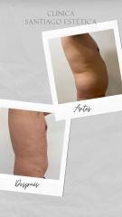 Liposucción - Clínica Santiago Estética