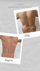 Liposucción - Clínica Santiago Estética