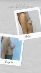 Aumento mamario - Clínica Santiago Estética