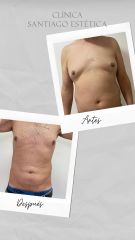 Liposucción - Clínica Santiago Estética