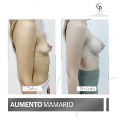 Aumento mamario - Clínica Santiago Estética