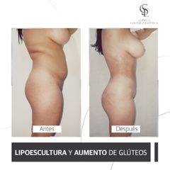 Lipoescultura - Clínica Santiago Estética