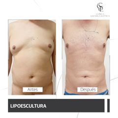 Liposucción - Clínica Santiago Estética