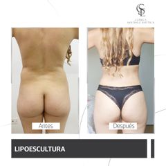 Liposucción - Clínica Santiago Estética