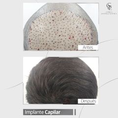 Implante Capilar - Clínica Santiago Estética