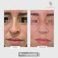 Rinoplastia - Clínica Santiago Estética