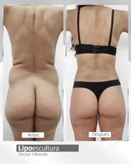 Liposucción - Clínica Santiago Estética
