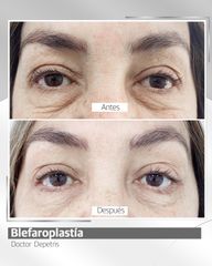 Blefaroplastia - Clínica Santiago Estética