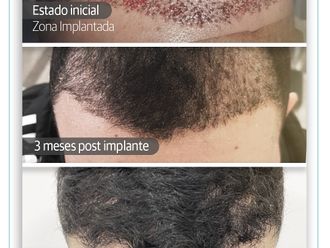 Implante Capilar antes y después - 837243