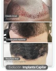 Antes y despues implante capilar.