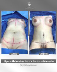 Lipo+Abdominoplastia+Aumento Mamario
