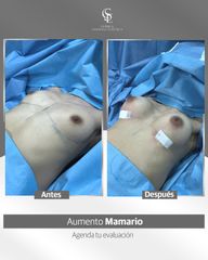 Aumento Mamario