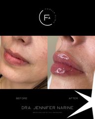 Aumento de labios - Dra. Jennifer Narine