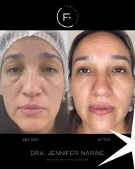 Rejuvenecimiento Facial - Dra. Jennifer Narine