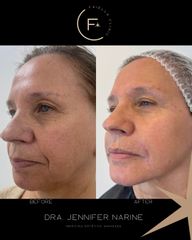 Rejuvenecimiento Facial - Dra. Jennifer Narine
